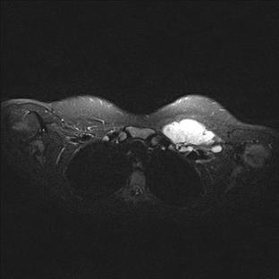 Enlarged lymph nodes, the biggest measuring 6x3 cm (transversal plane)