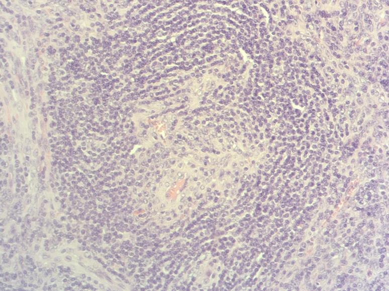 HE, x200: Mantle zones are thickened with lymphocytes arranged in layers-"onion skin pattern"