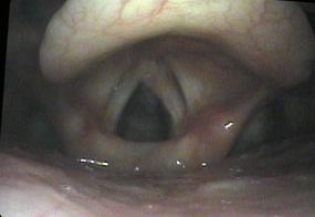 Normal vocal cords
