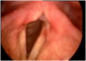 Right vocal cord polyp