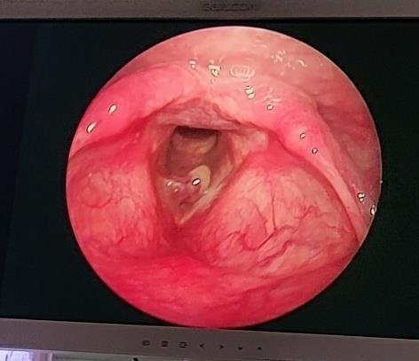 Micro laryngeal surgery and excision of the polyp