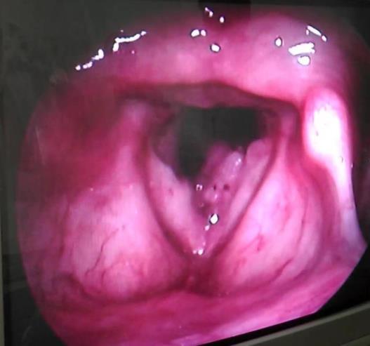 Micro laryngeal surgery and excision of the polyp