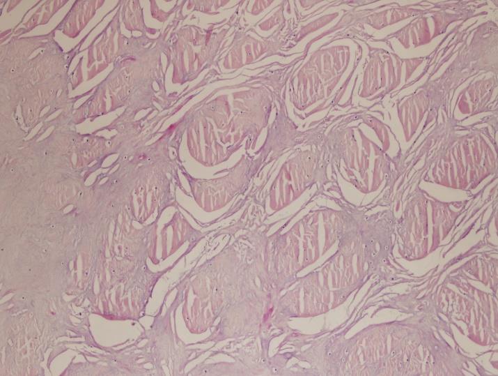 Hyalinization and chondroid degeneration at 10x staining with Hematoxylin-eosin (H&E)