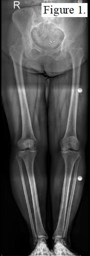 Preoperative X-ray of a patient with graft
