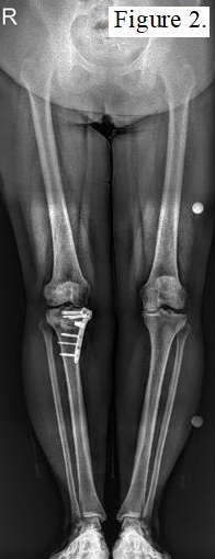 Postoperative X-ray of a patient with graft