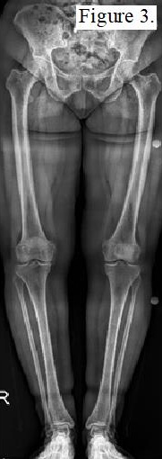 Preoperative X-ray of a patient without graft