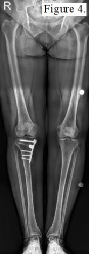 Postoperative X-ray of a patient without graft