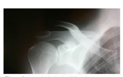 Acromioclavicular dislocation; radiological aspect