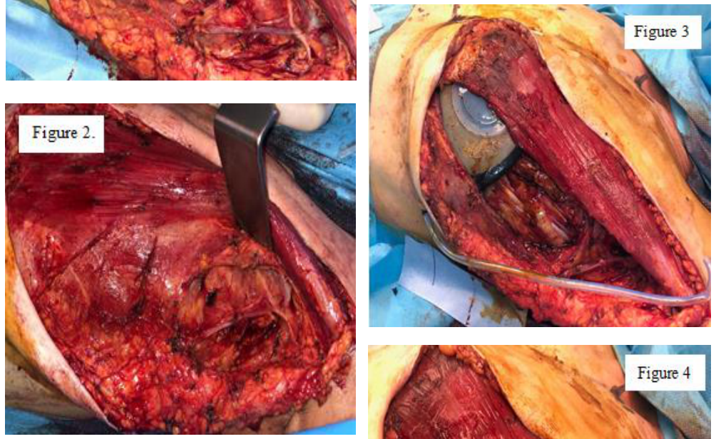 and 2. The aspect of the axila and pectoral muscle after mastectomy and axillary lymphadentectomy.