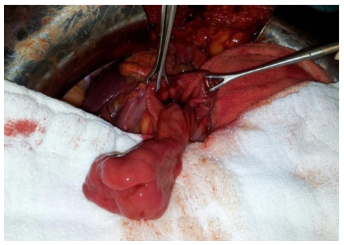 Image of the ulcerative mass in the duodenum during surgery