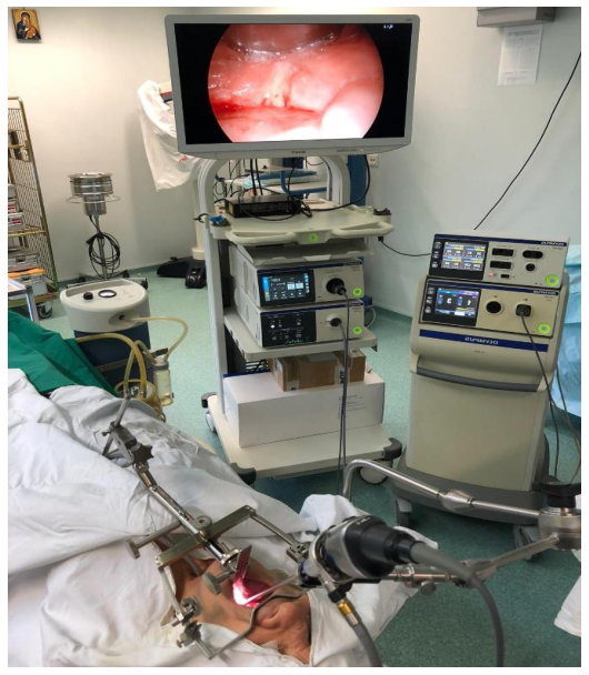 TOUSS setup with pharyngo-laryngeal retractor and 0-degree rigid laparoscope mounted. Endoscopic view with 4k resolution and 2D vision.