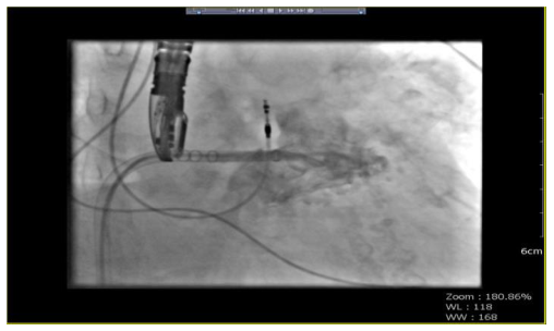 PFO closing with a PFO-Amplatzer occlusion device (25 mm), TEE controlled