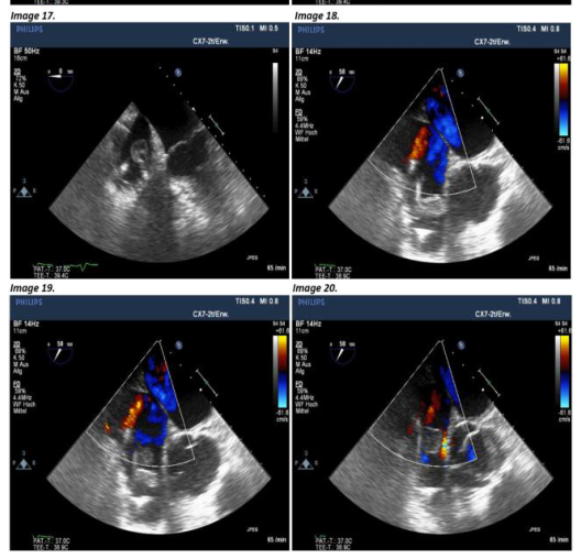 Endocarditis associated with heterogeneous intracardiac implanted materials