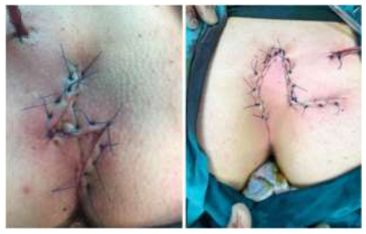 Z-plasty and Limberg Flaps