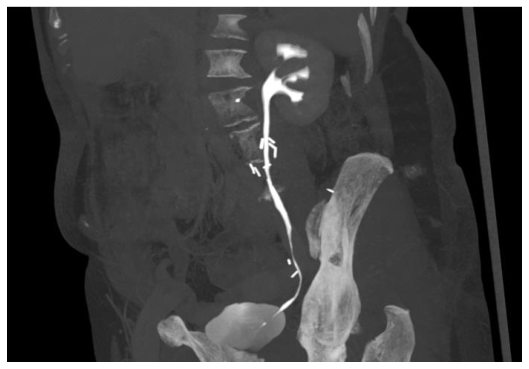 A computerized tomography of the patient after 33 months demonstrated normal ureteral views at both sides.