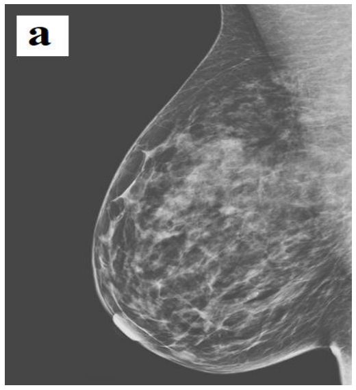 On gray scale ultrasonography, a superficial, well-contoured, oval-shaped, hypoechoic solid lesion is observed in the left axilla. Unlike lymph nodes, echogenic hilus cannot be distinguished in the lesion. Also, note that there is no sonographic finding compatible with accessory breast tissue.